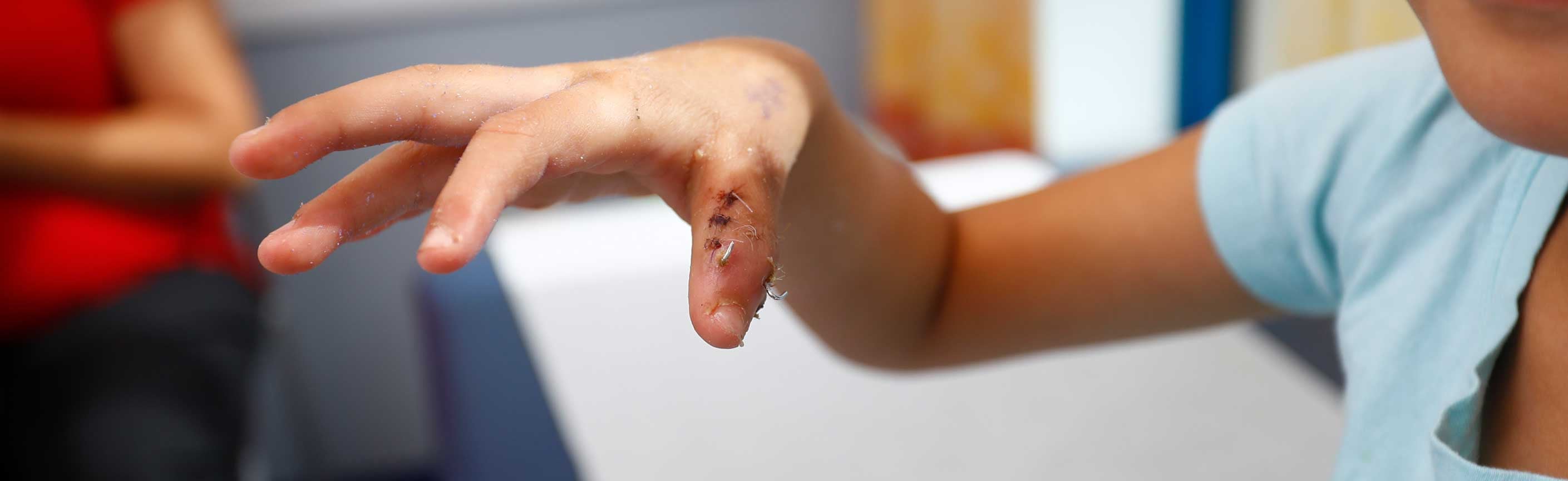 Girl's hand with stiches