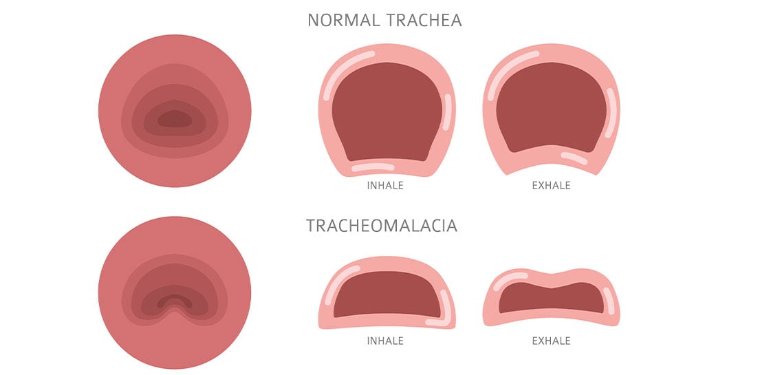 Normal and abnormal views (tracheomalacia) of a trachea