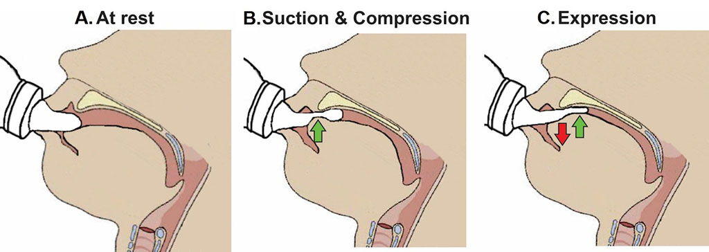 QUAN-Fig-1---quantitative-sucking-in-neonates