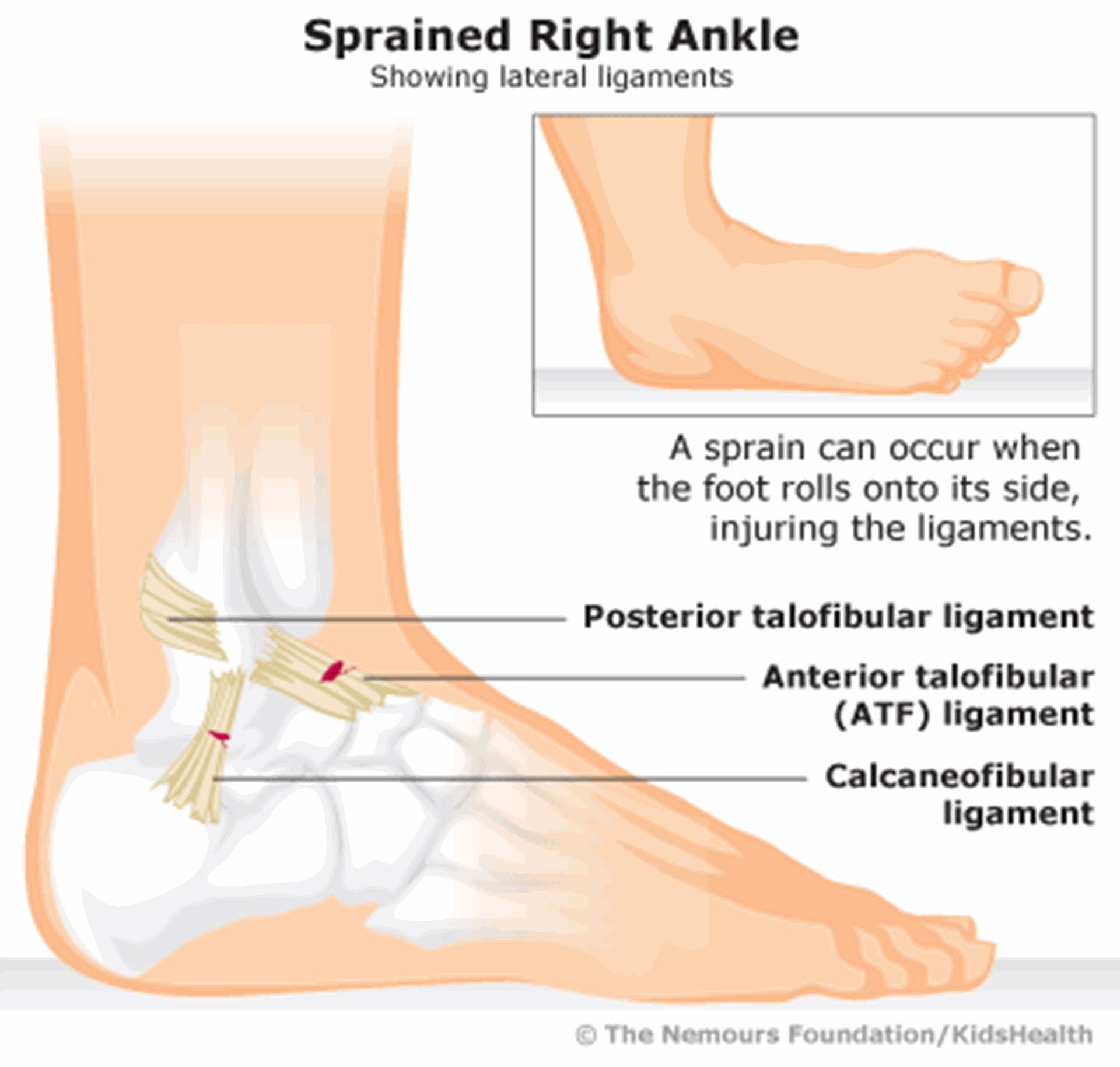 anklesprain-400x381-rd1-enil-main