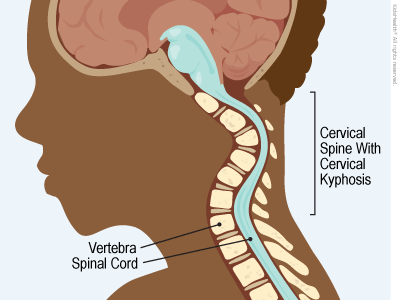 Cervical Spine with Cervical Kyphosis