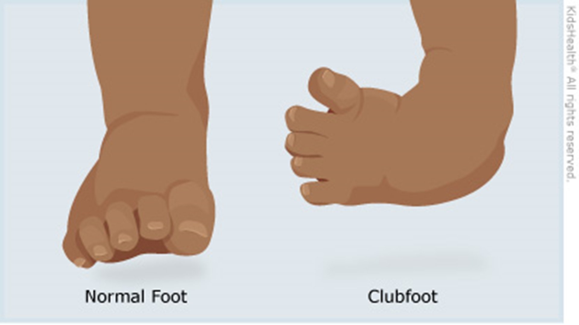 Clubfoot