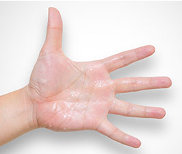 Prespiring hand with hyperhidrosis