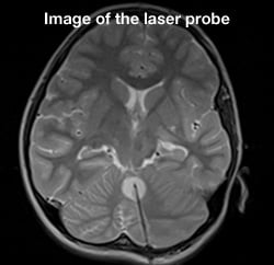 Image of the laser probe