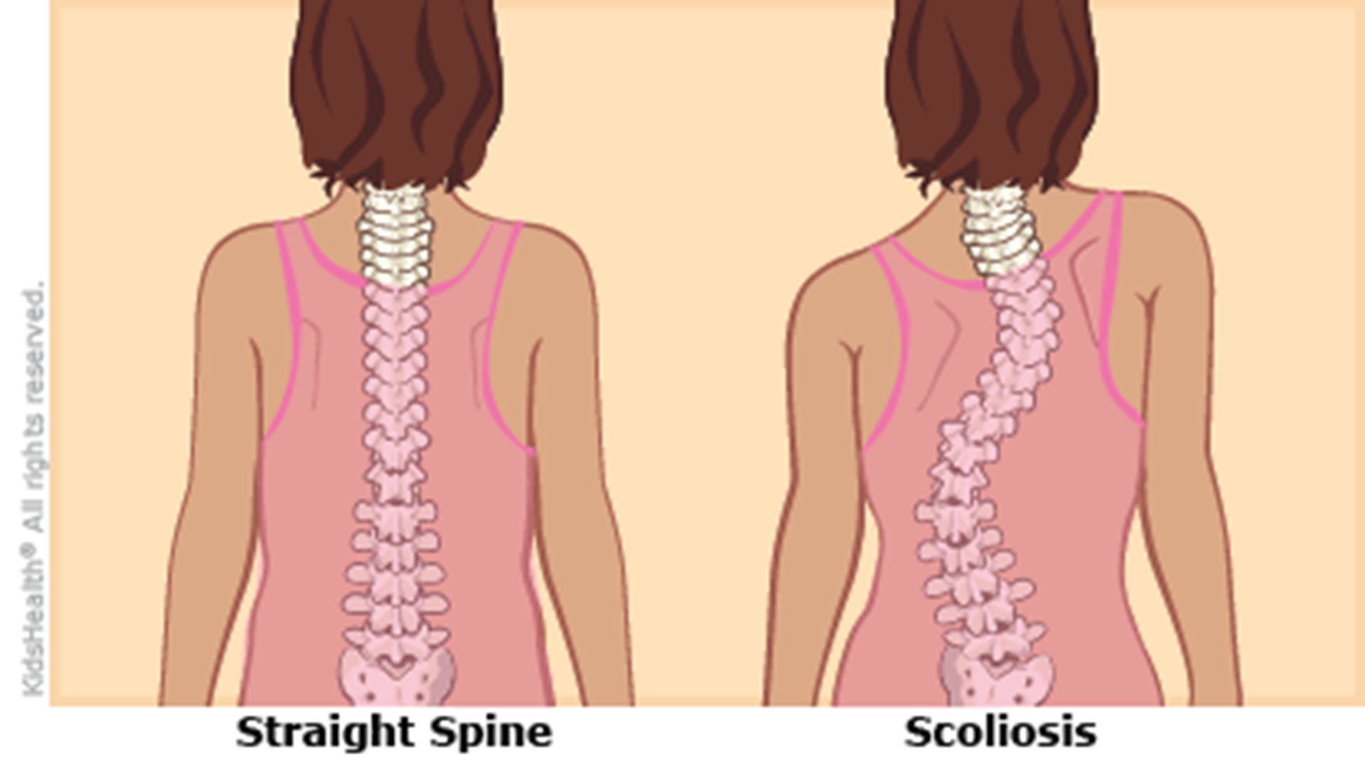 scoliosiscroppeda-415x233-enil-main.png