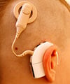 photo-cochleardevice2