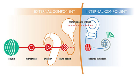 photo-cochlearprocess